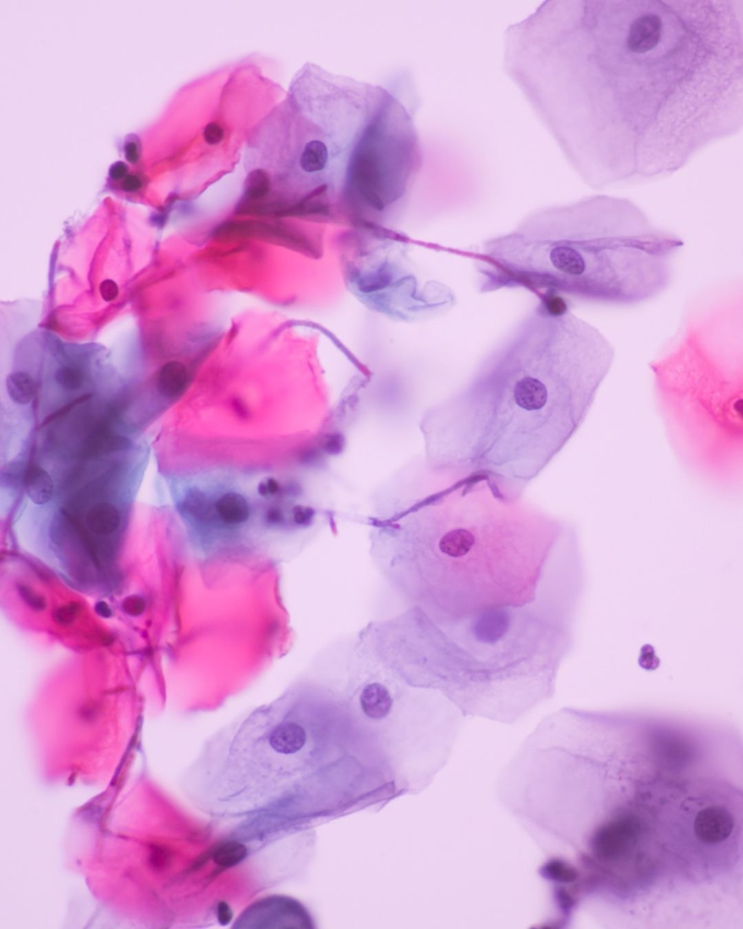 Diagnostic Hysteroscopy & Uterine Antibiotic Washes